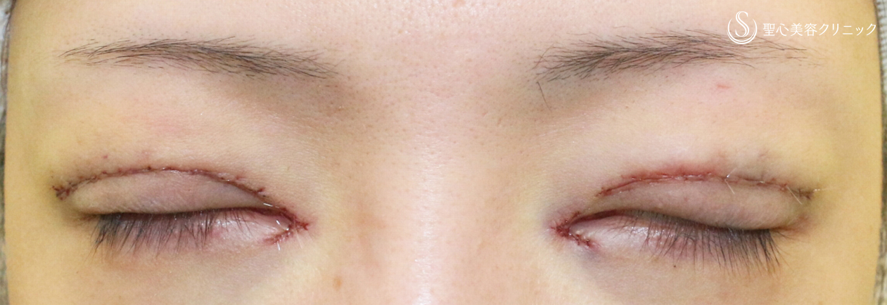 【30代女性・広すぎる二重の他院修正例】二重全切開+α法＆目頭切開→癒着による凹み目にヒアルロン酸（5年5ヶ月後） Before 