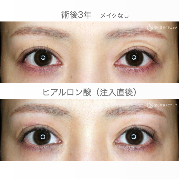 【30代女性・広すぎる二重の他院修正例】二重全切開+α法＆目頭切開→癒着による凹み目にヒアルロン酸（5年5ヶ月後） Before 