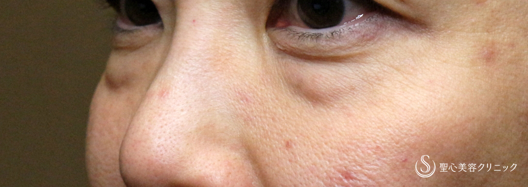 【40代女性・目の下のクマ＆タルミにあえて表ハムラを行う理由】表ハムラ+α法 単独例（直後〜10ヶ月後） Before 