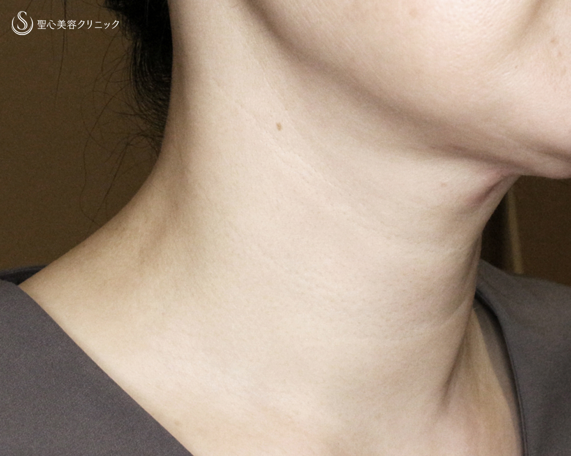 【40代女性・難易度「特級」の首の横ジワ】プレミアムPRP皮膚再生療法（6年後） After 