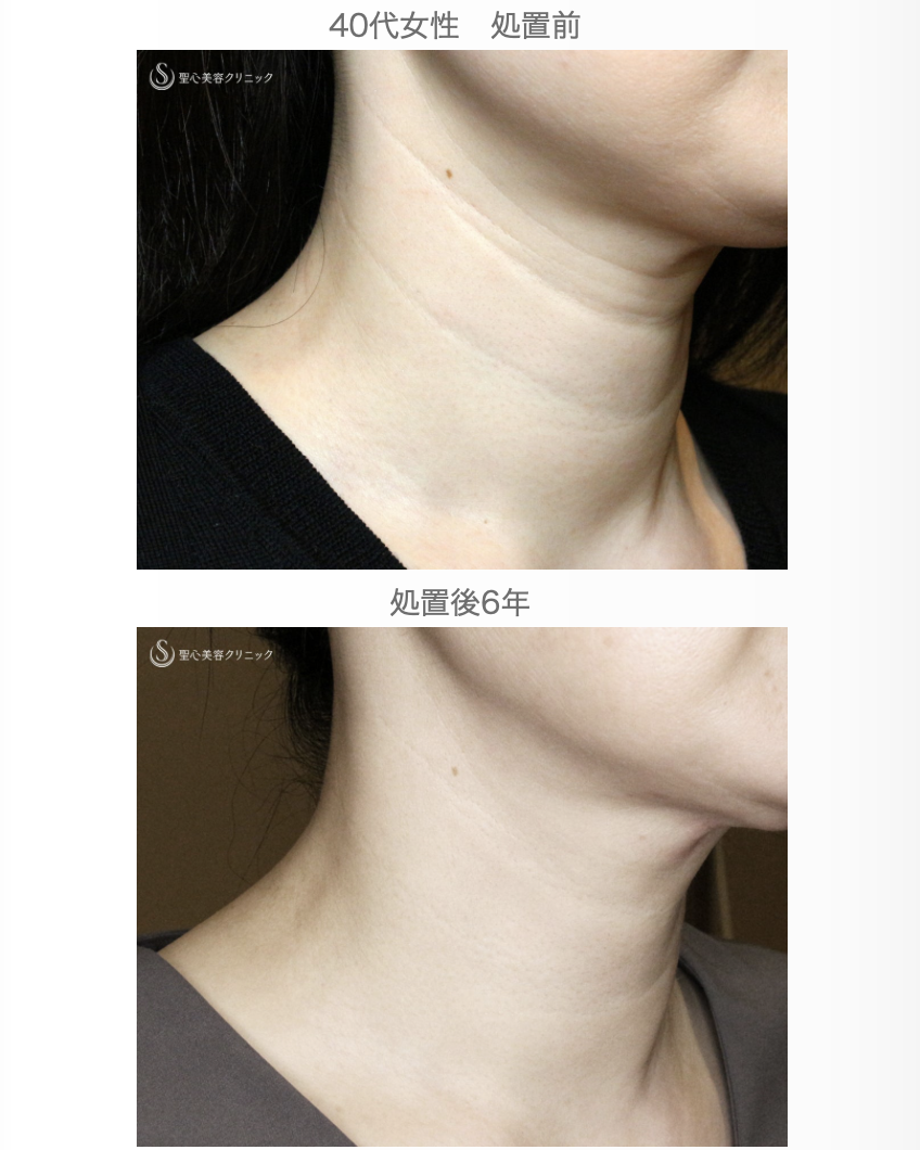 【40代女性・難易度「特級」の首の横ジワ】プレミアムPRP皮膚再生療法（6年後） After 