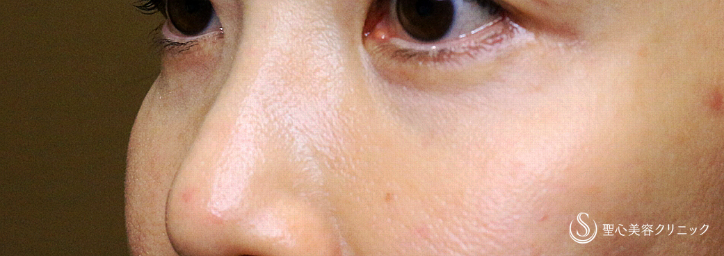 【40代女性・目の下のクマ＆タルミにあえて表ハムラを行う理由】表ハムラ+α法 単独例（直後〜10ヶ月後） After 