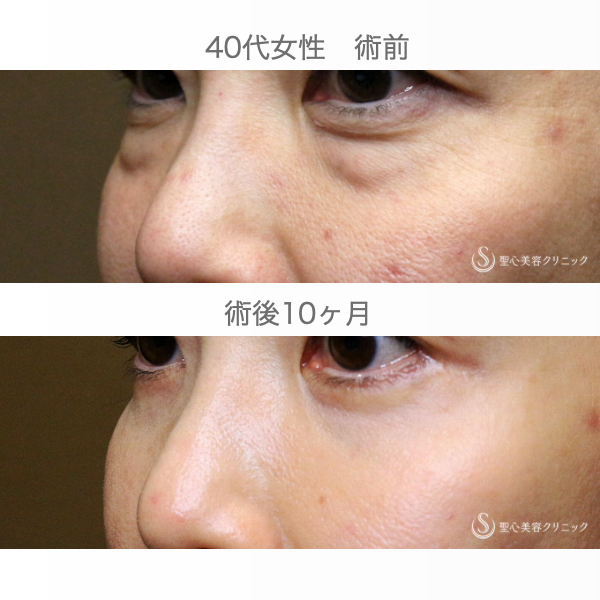 【40代女性・目の下のクマ＆タルミにあえて表ハムラを行う理由】表ハムラ+α法 単独例（直後〜10ヶ月後） After 
