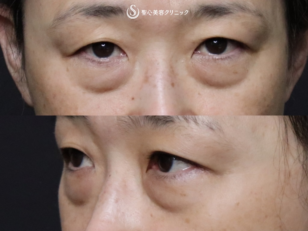 【50代女性・目の下の若返り】結膜側脱脂+プレミアムPRP皮膚再生療法（術後1か月） Before 