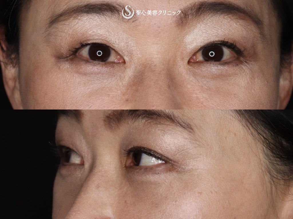 【50代女性・目の下の若返り】結膜側脱脂+プレミアムPRP皮膚再生療法（術後1か月） After 