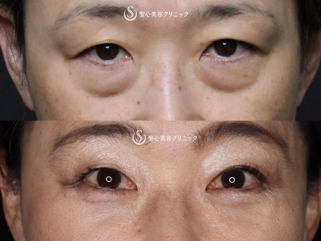 【50代女性・目の下の若返り】結膜側脱脂+プレミアムPRP皮膚再生療法（術後1か月） After 