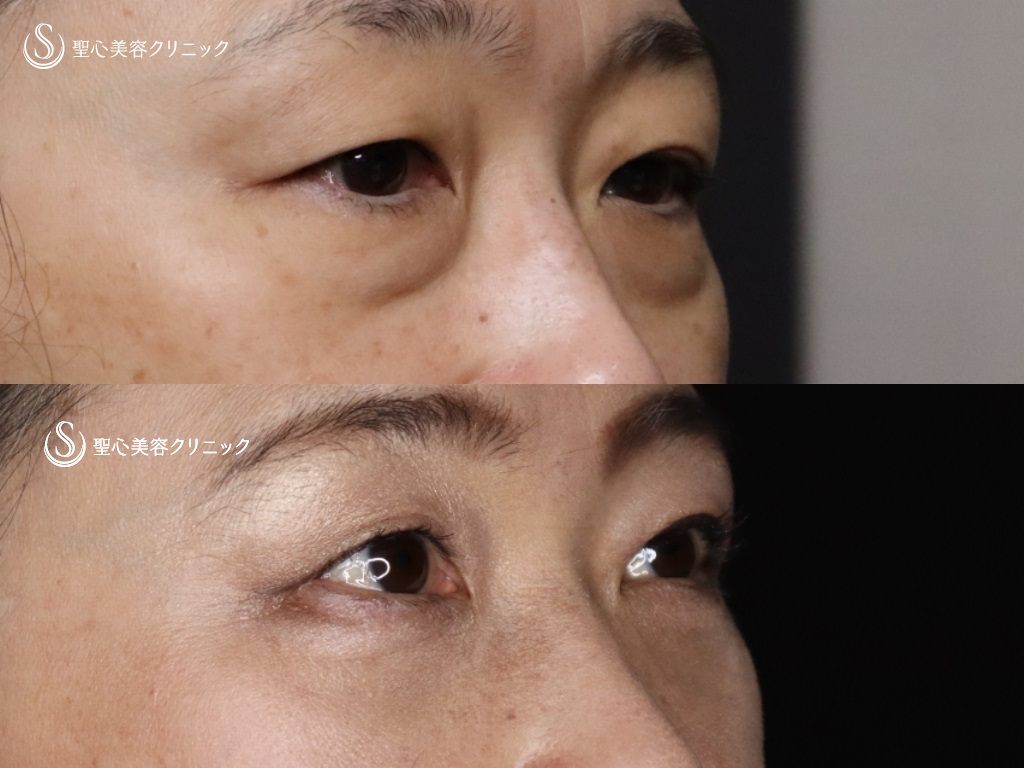 【50代女性・目の下の若返り】結膜側脱脂+プレミアムPRP皮膚再生療法（術後1か月） After 