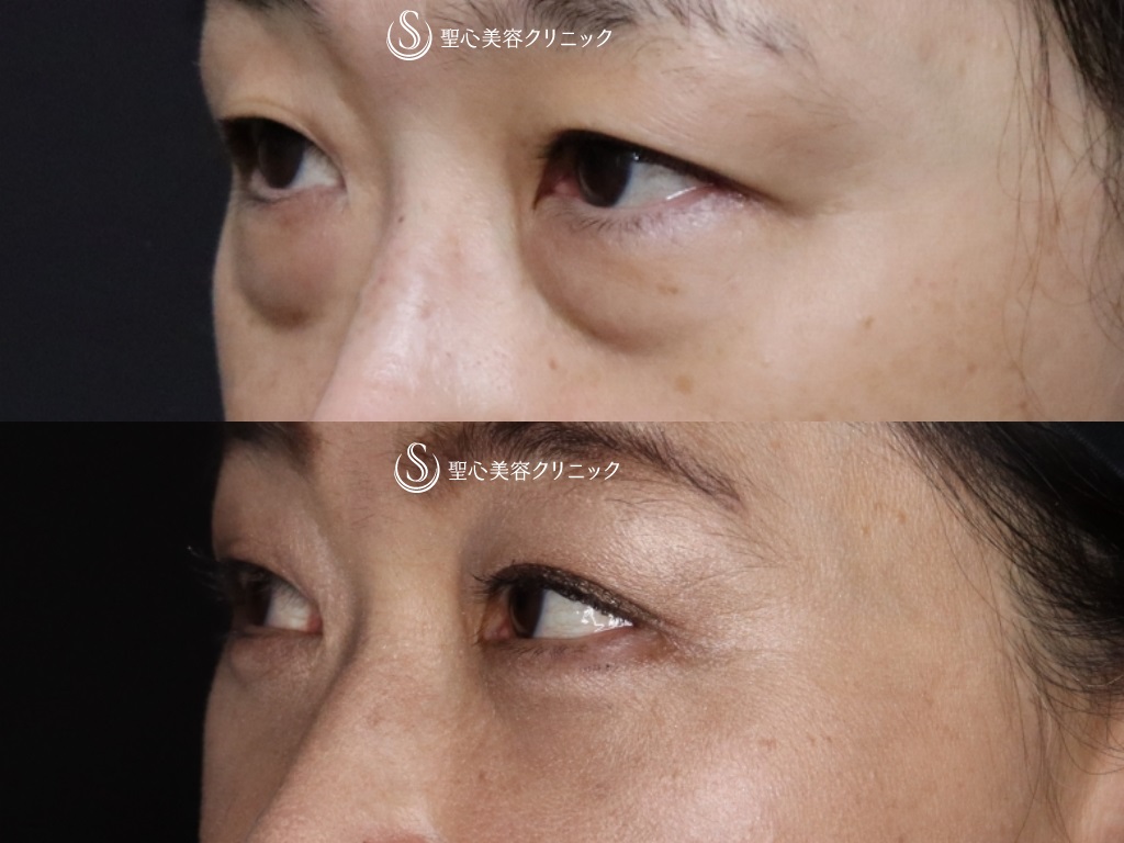 【50代女性・目の下の若返り】結膜側脱脂+プレミアムPRP皮膚再生療法（術後1か月） After 