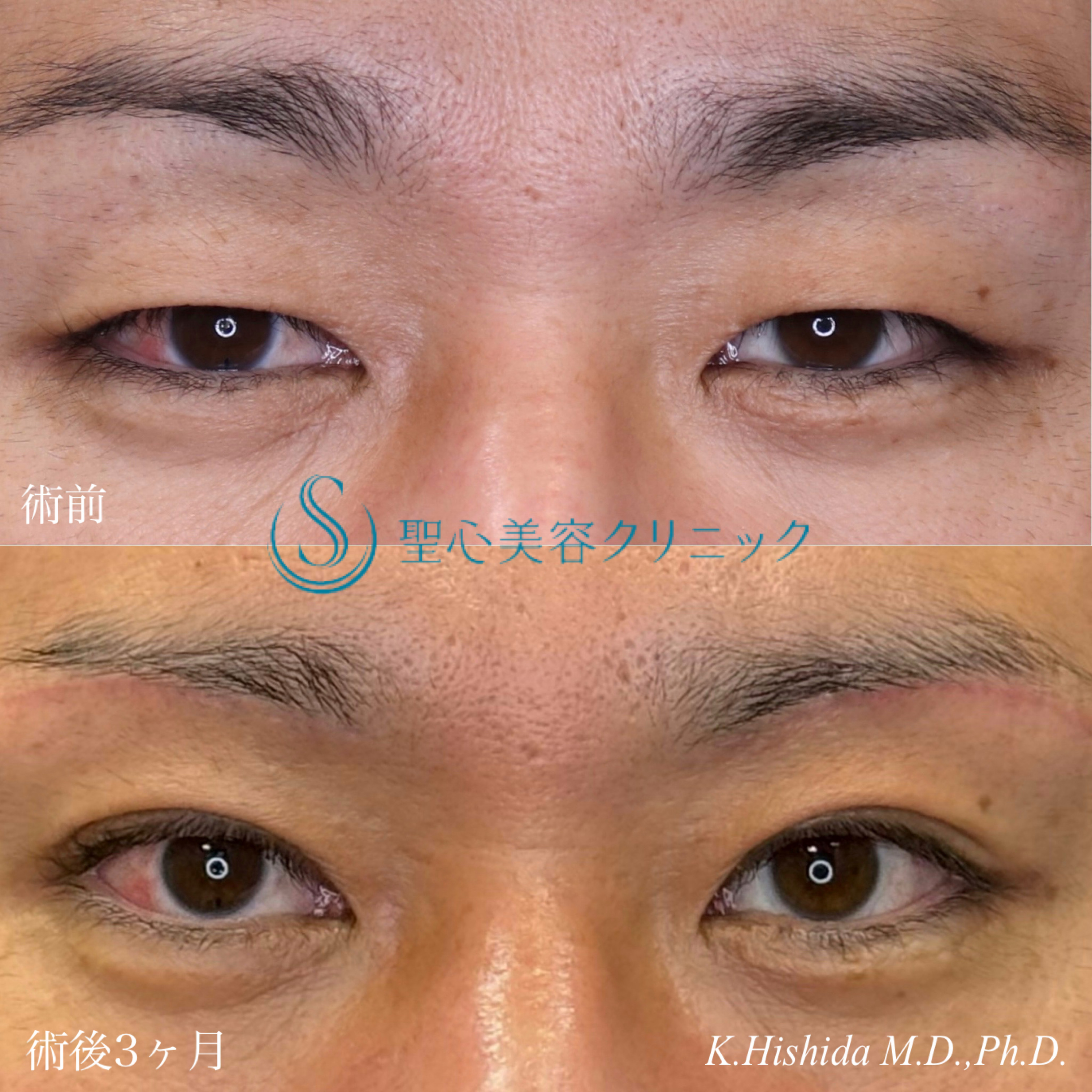【30代男性・ナチュラルでスッキリとした二重に！！】眉下切開法＋マイクロメソッド＋α（3点固定）（術後3ヶ月） After 
