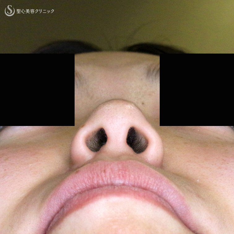 【20代女性・鼻の穴が見えない「忘れ鼻」へ】小鼻縮小術+α法「Ver.5」（4年後） After 
