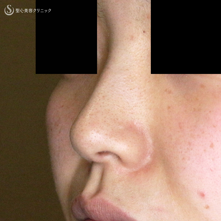 【20代女性・鼻の穴が見えない「忘れ鼻」へ】小鼻縮小術+α法「Ver.5」（4年後） After 