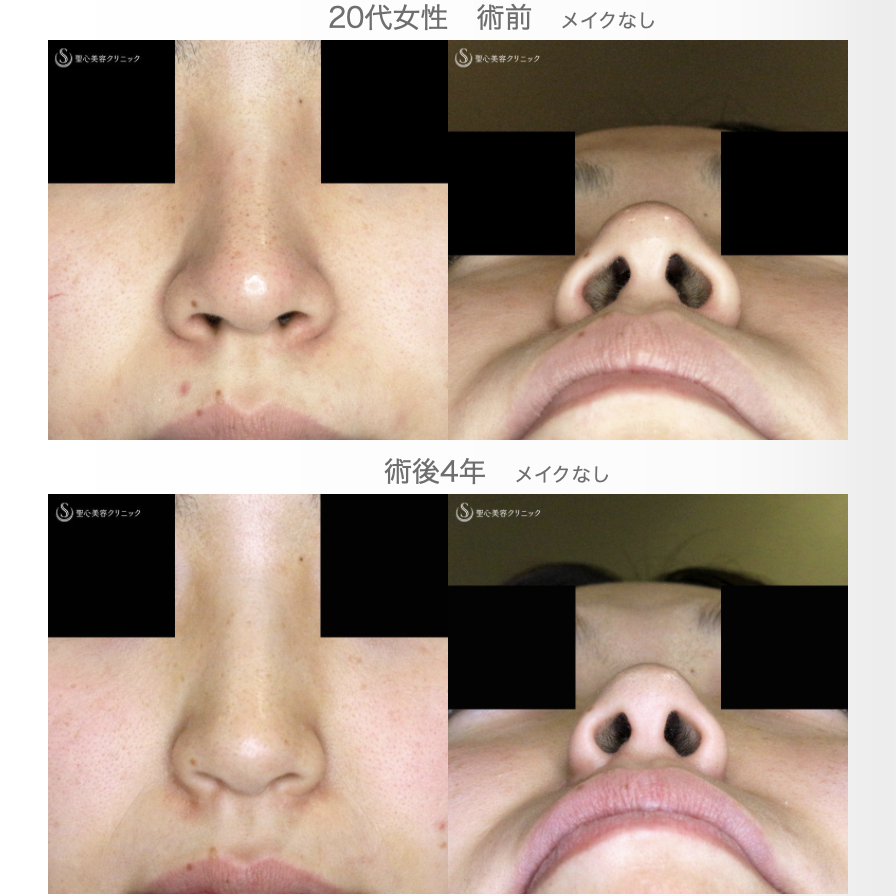 【20代女性・鼻の穴が見えない「忘れ鼻」へ】小鼻縮小術+α法「Ver.5」（4年後） Before 