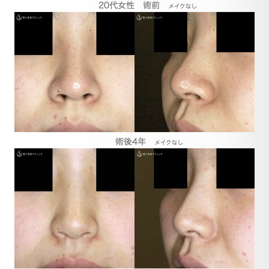 【20代女性・鼻の穴が見えない「忘れ鼻」へ】小鼻縮小術+α法「Ver.5」（4年後） Before 
