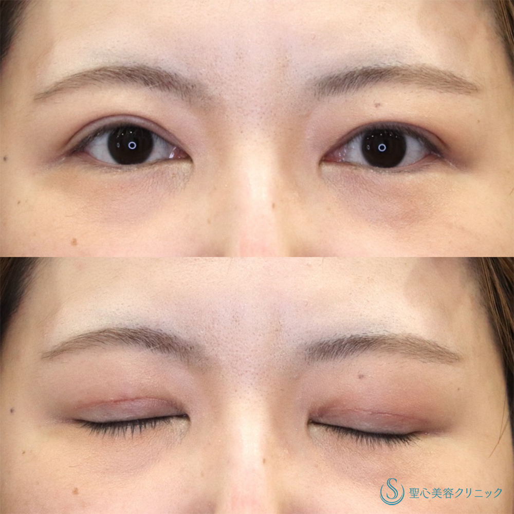 【30代女性・他院の修正】眼瞼下垂（切開法/腱膜縫縮法）（1ヶ月後） After 