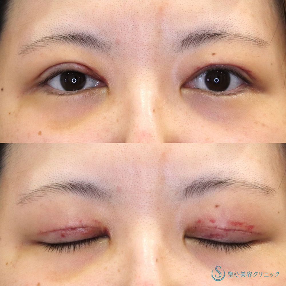 【30代女性・他院の修正】眼瞼下垂（切開法/腱膜縫縮法）（1ヶ月後） After 