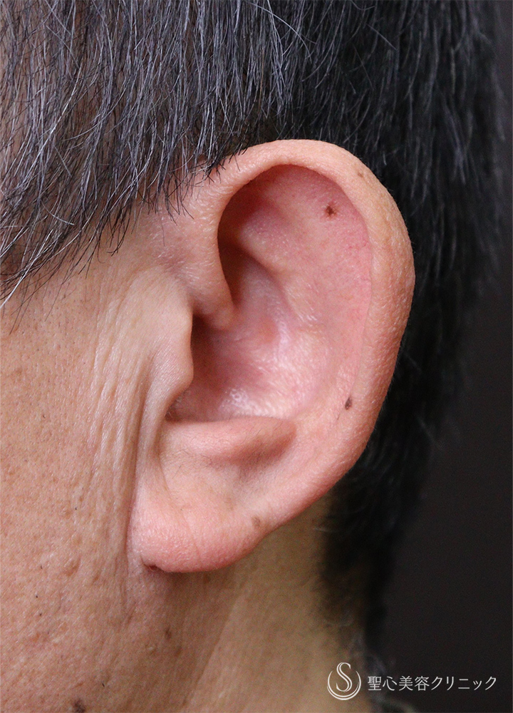 【60代男性・立ち耳】立ち耳修正(埋没法)（1ヶ月） Before 
