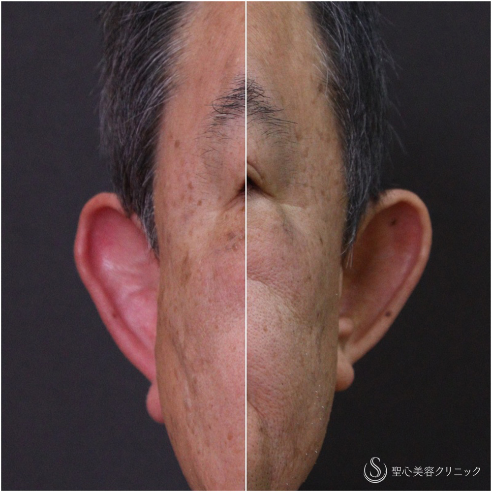 【60代男性・立ち耳】立ち耳修正(埋没法)（1ヶ月） Before 