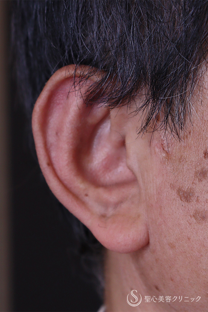 【60代男性・立ち耳】立ち耳修正(埋没法)（1ヶ月） After 