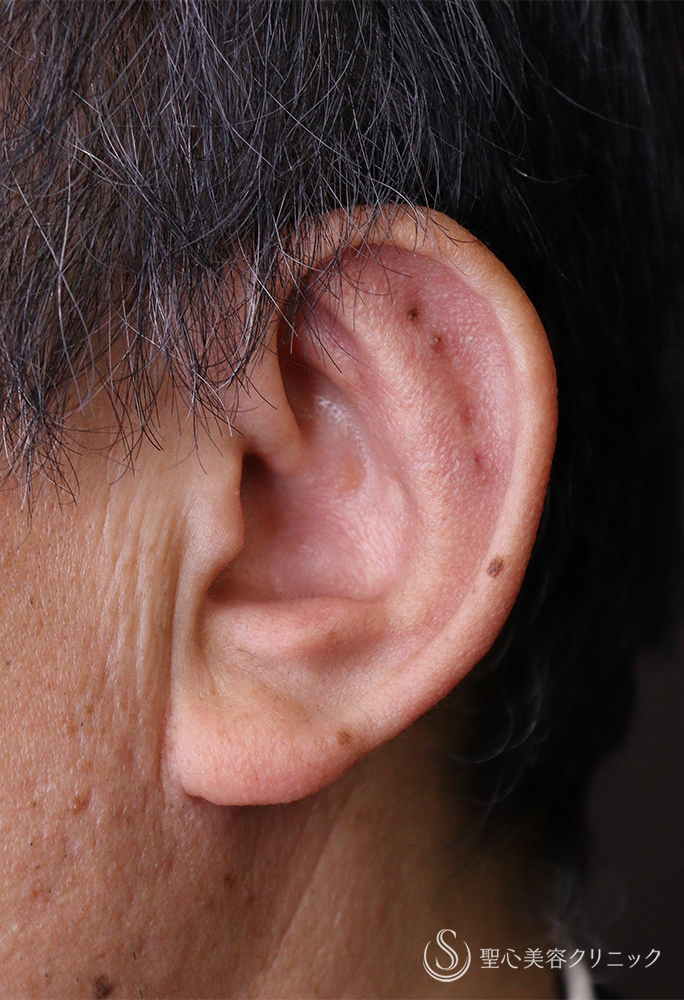 【60代男性・立ち耳】立ち耳修正(埋没法)（1ヶ月） After 
