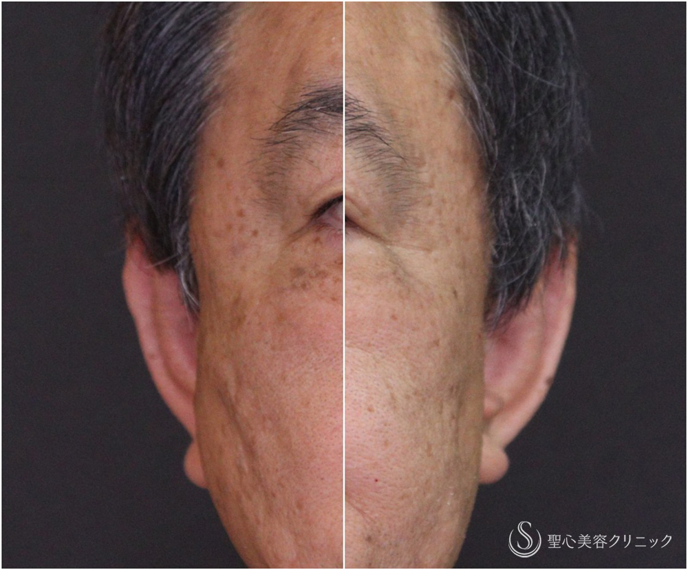 【60代男性・立ち耳】立ち耳修正(埋没法)（1ヶ月） After 