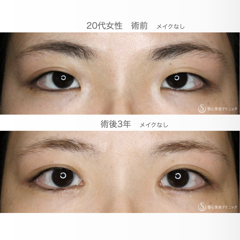 【20代女性・目頭切開だけで二重までくっきり】目頭切開+α法 単独（3年後） After 