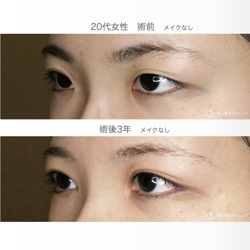 【20代女性・目頭切開だけで二重までくっきり】目頭切開+α法 単独（3年後） After 