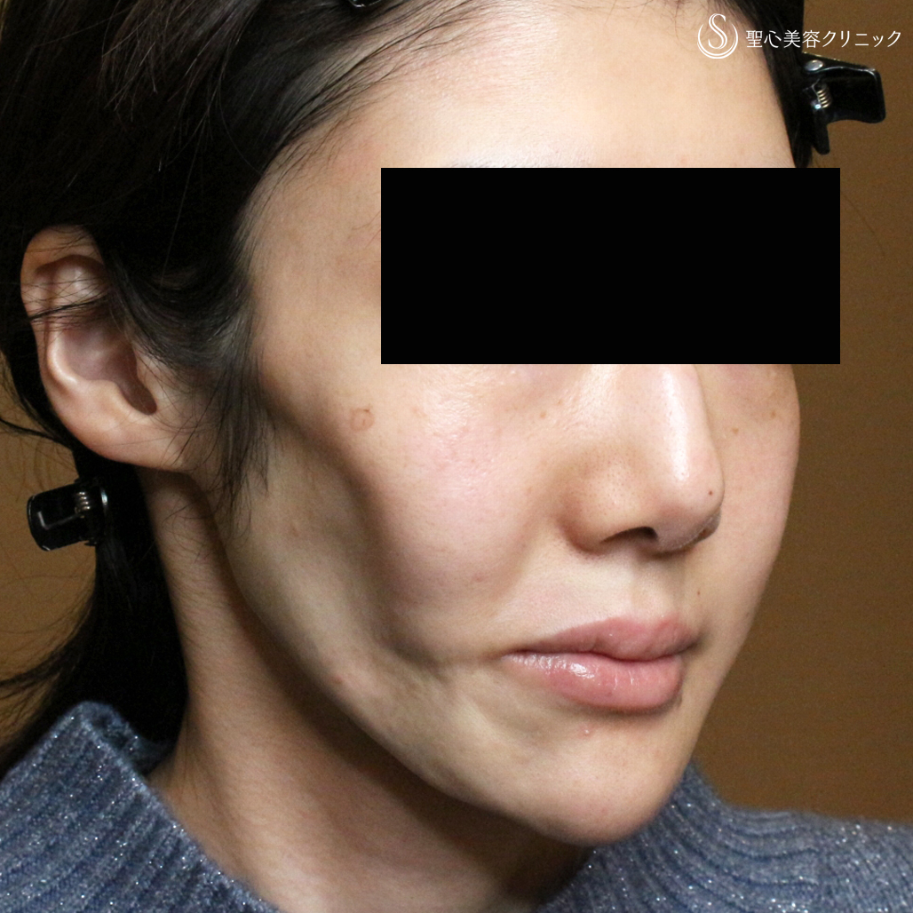 【30代女性・進行性顔面片側萎縮症（ロンバーグ病）】プレミアムPRP皮膚再生療法（直後〜1年4ヶ月後） Before 