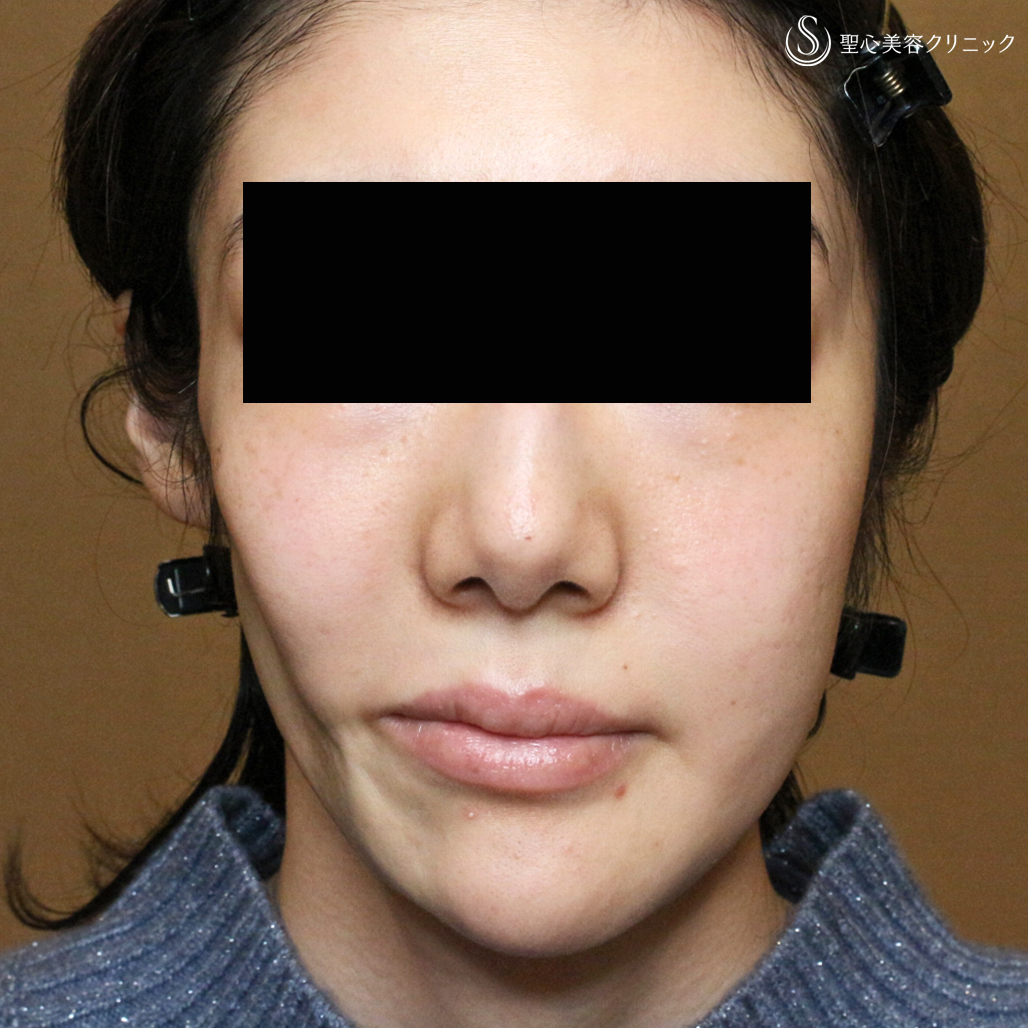 【30代女性・進行性顔面片側萎縮症（ロンバーグ病）】プレミアムPRP皮膚再生療法（直後〜1年4ヶ月後） Before 