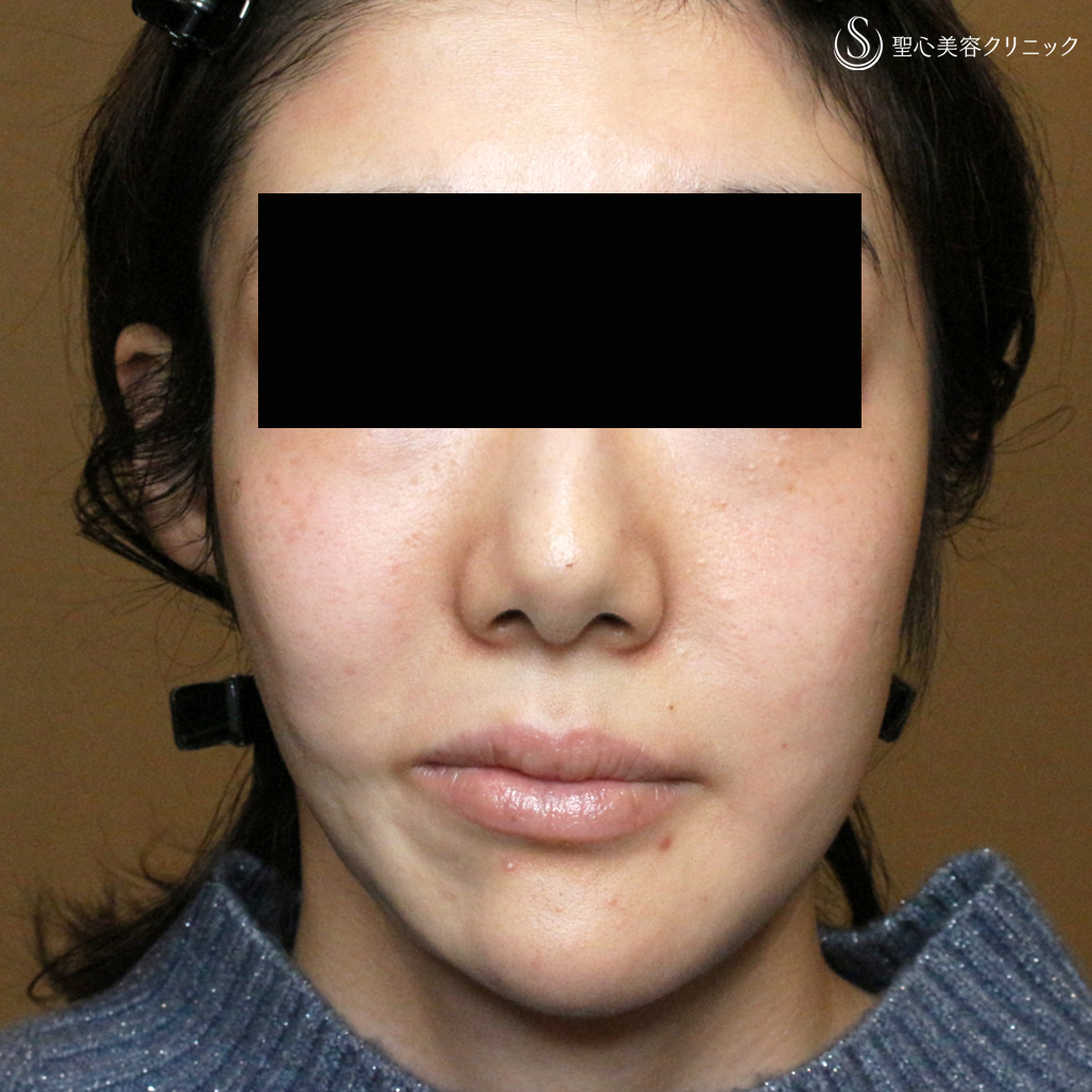 【30代女性・進行性顔面片側萎縮症（ロンバーグ病）】プレミアムPRP皮膚再生療法（直後〜1年4ヶ月後） Before 