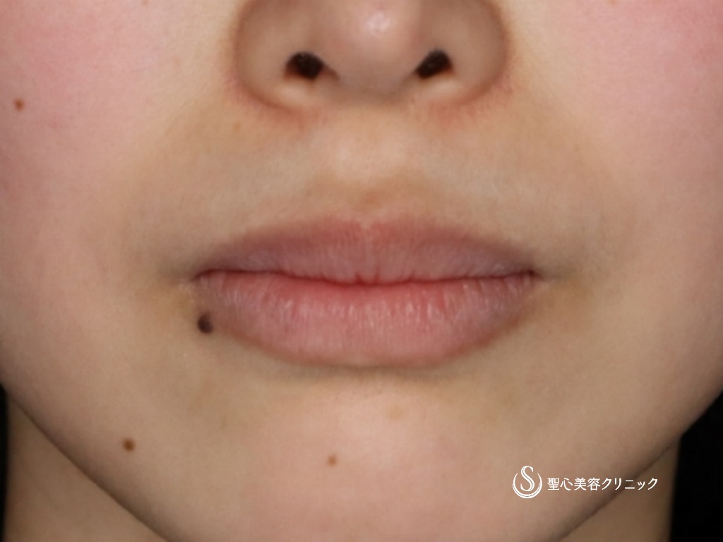 【20代女性・口角を挙げて印象を良くしたい】プレミアム口角挙上術（4ヶ月後） Before 