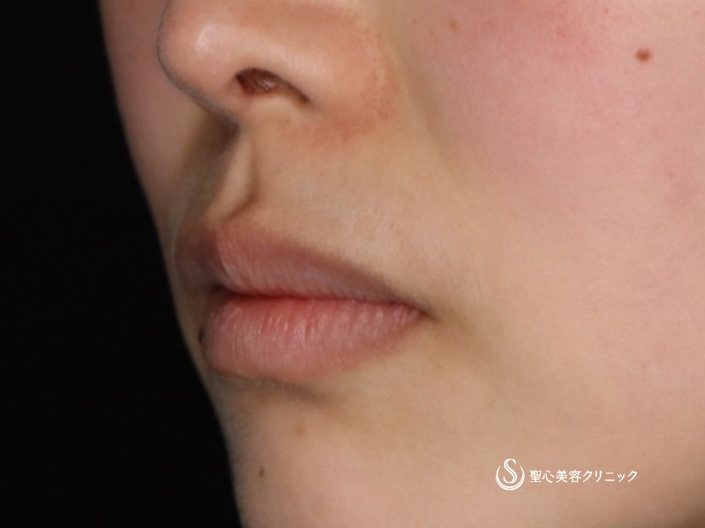 【20代女性・口角を挙げて印象を良くしたい】プレミアム口角挙上術（4ヶ月後） Before 