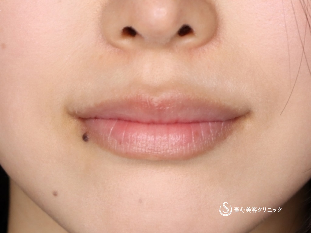 【20代女性・口角を挙げて印象を良くしたい】プレミアム口角挙上術（4ヶ月後） After 