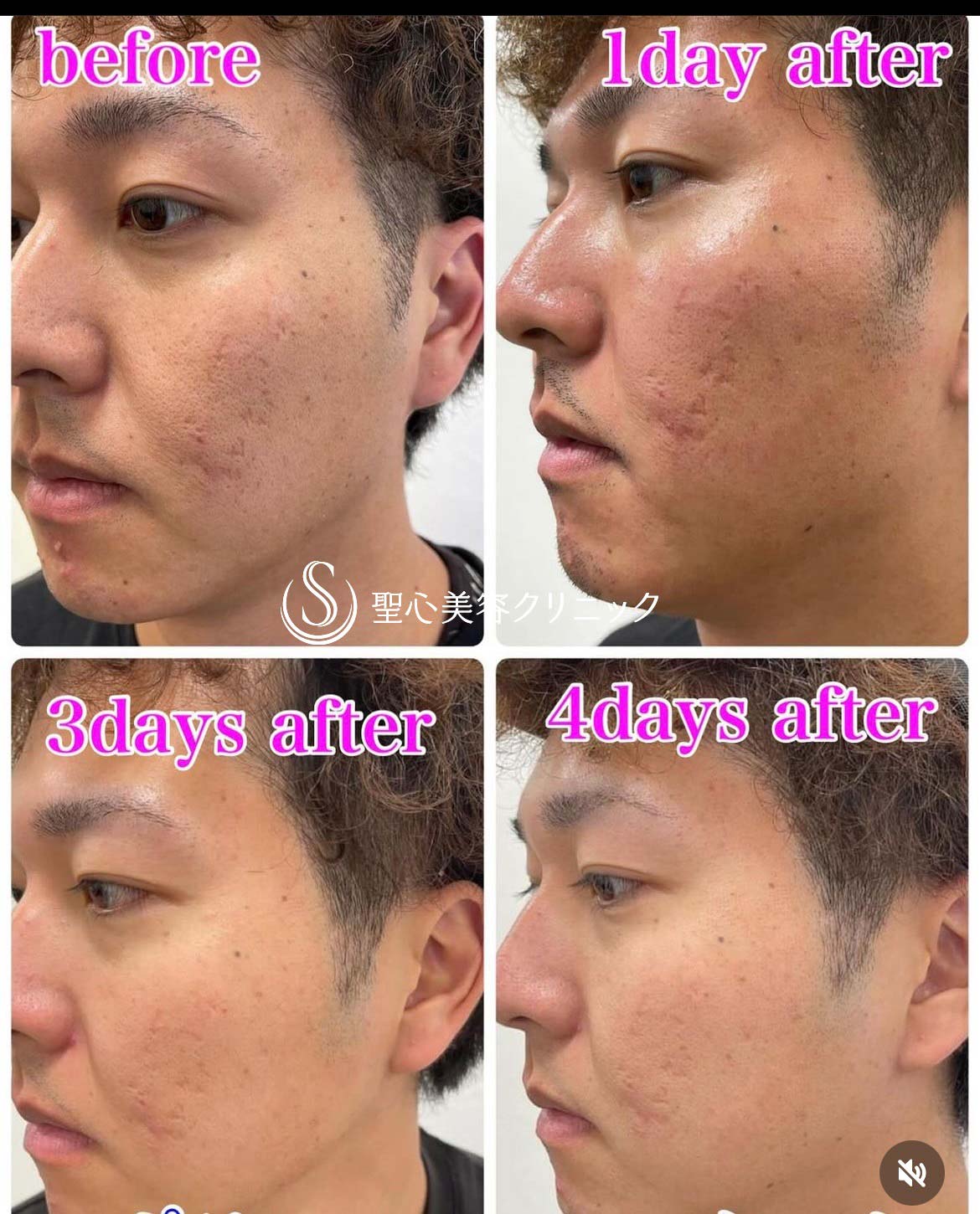 【30代男性・クレーター、毛穴治療】 POTENZA（ポテンツァ）（3ヶ月後） After 