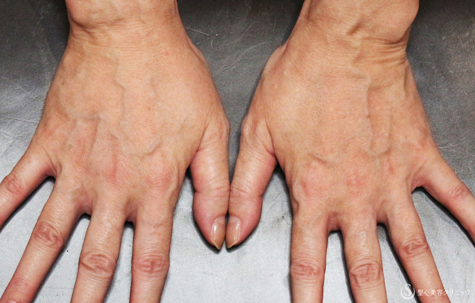 【50代女性・別次元の手の甲の若返り】プレミアムPRP皮膚再生療法（13年後） After 