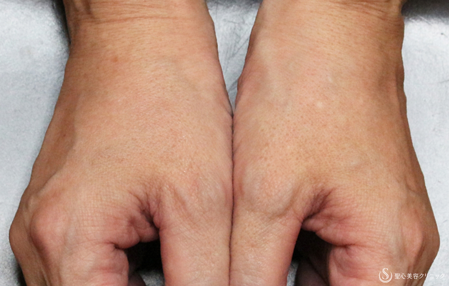 【50代女性・別次元の手の甲の若返り】プレミアムPRP皮膚再生療法（13年後） After 