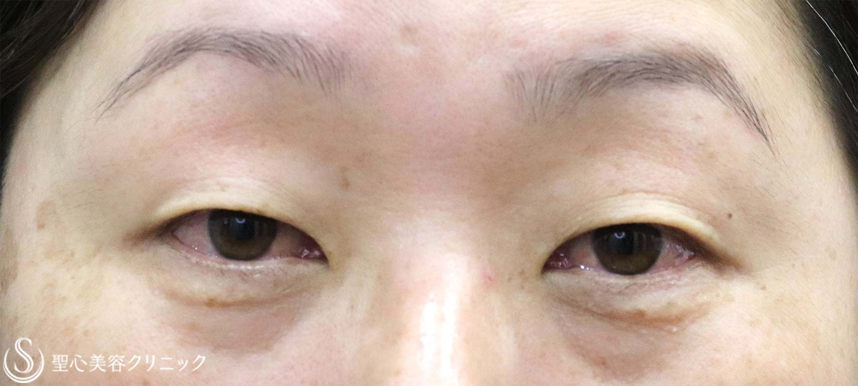 【40代女性・瞼が重い】マイクロメソッド＋α（1ヶ月後） Before 
