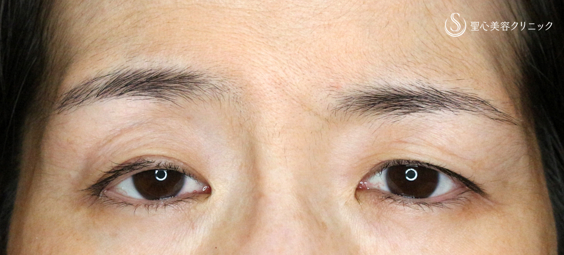 【40代女性・左右差のあるコンタクトレンズ眼瞼下垂】切らない眼瞼下垂+α法（術直後） Before 