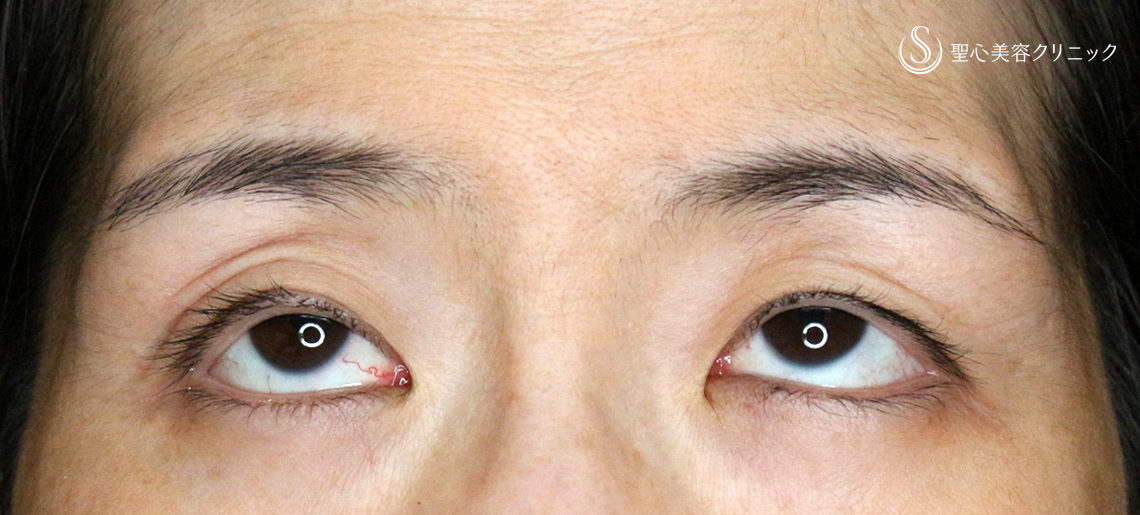 【40代女性・左右差のあるコンタクトレンズ眼瞼下垂】切らない眼瞼下垂+α法（術直後） Before 