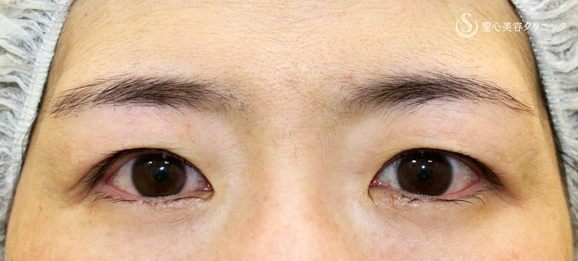 【40代女性・左右差のあるコンタクトレンズ眼瞼下垂】切らない眼瞼下垂+α法（術直後） After 