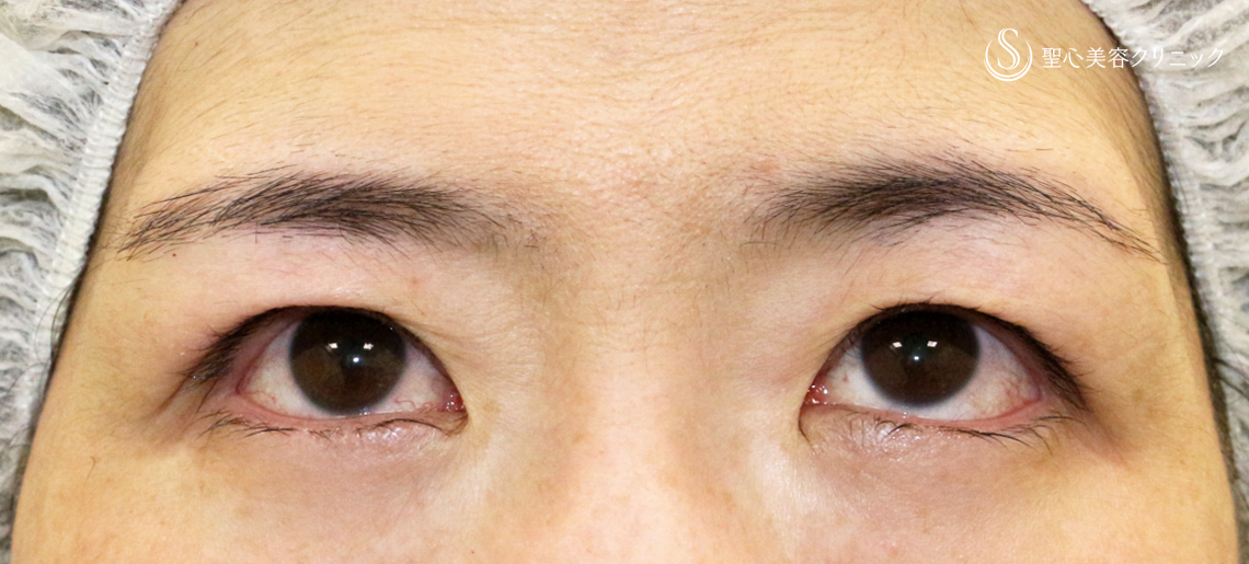 【40代女性・左右差のあるコンタクトレンズ眼瞼下垂】切らない眼瞼下垂+α法（術直後） After 