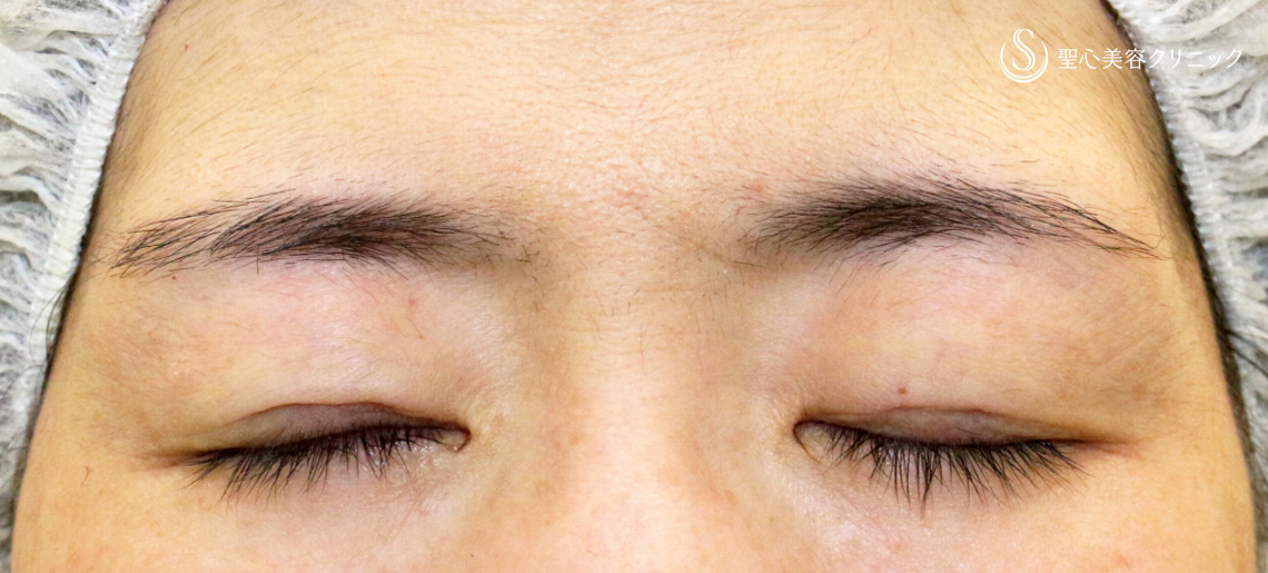 【40代女性・左右差のあるコンタクトレンズ眼瞼下垂】切らない眼瞼下垂+α法（術直後） After 