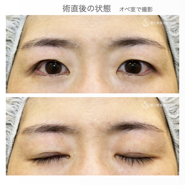 【40代女性・左右差のあるコンタクトレンズ眼瞼下垂】切らない眼瞼下垂+α法（術直後） After 
