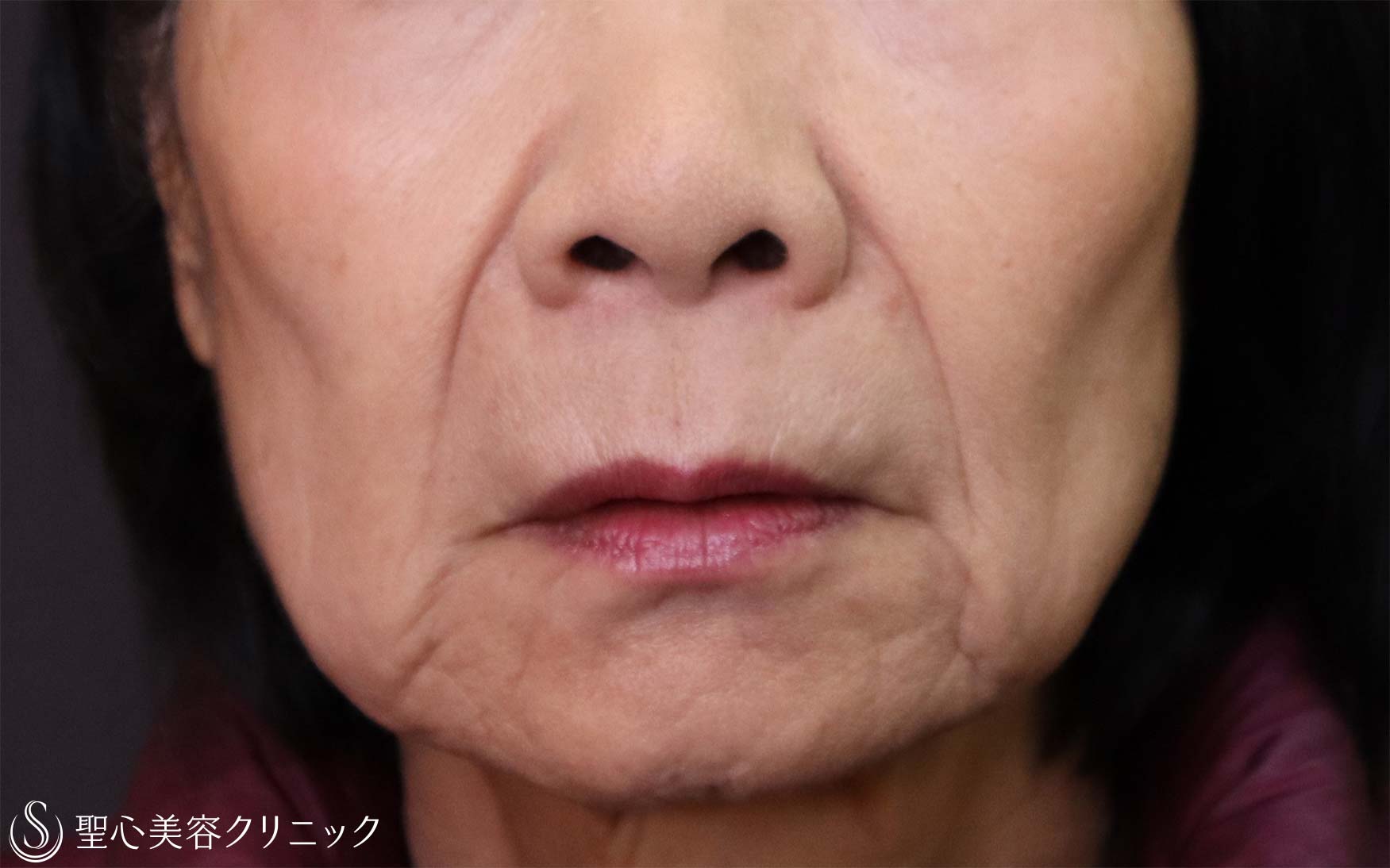 【80代女性・ほうれい線】プレミアムPRP皮膚再生療法（処置後11か月） After 