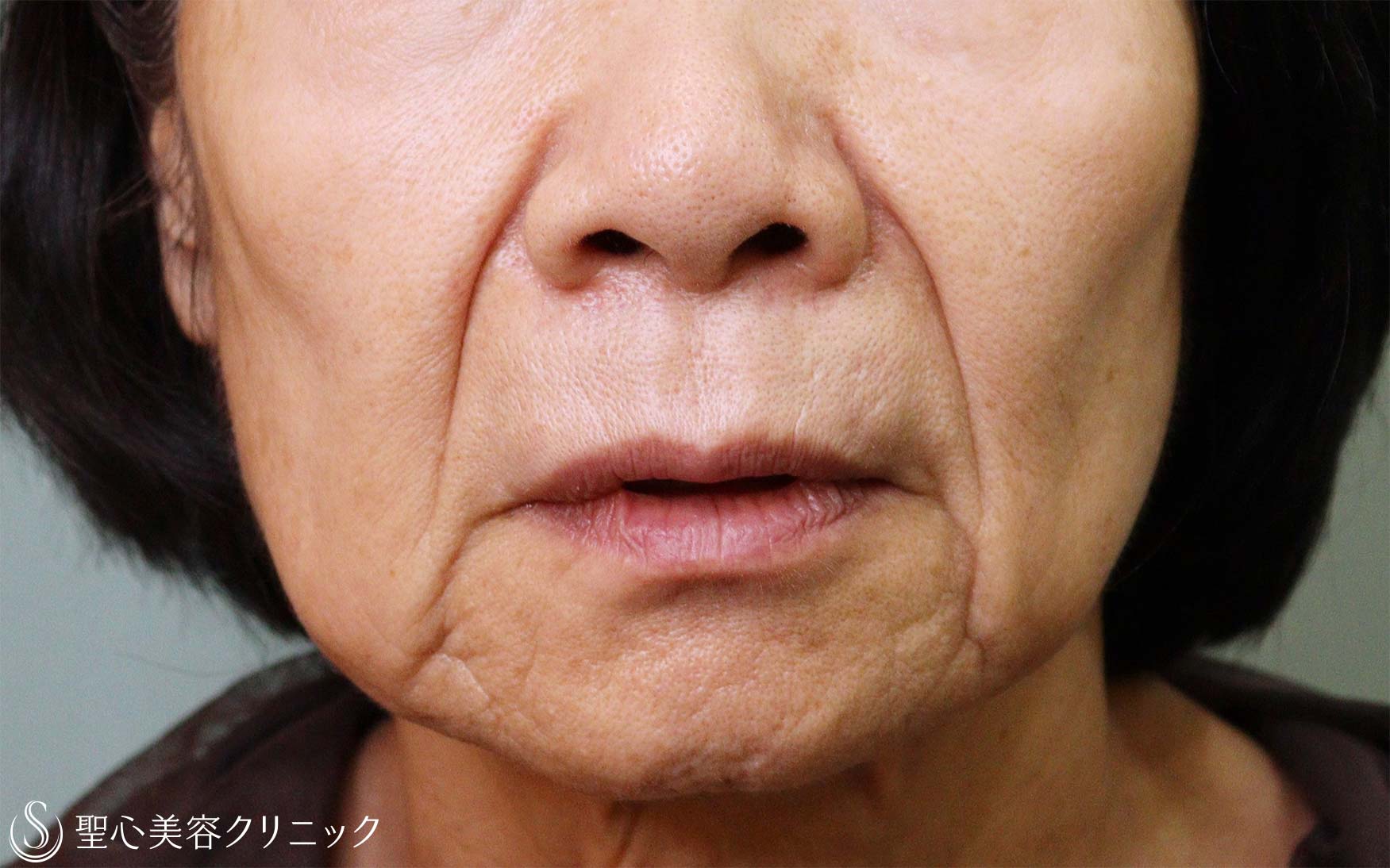80代女性・ほうれい線】プレミアムPRP皮膚再生療法（処置後11か