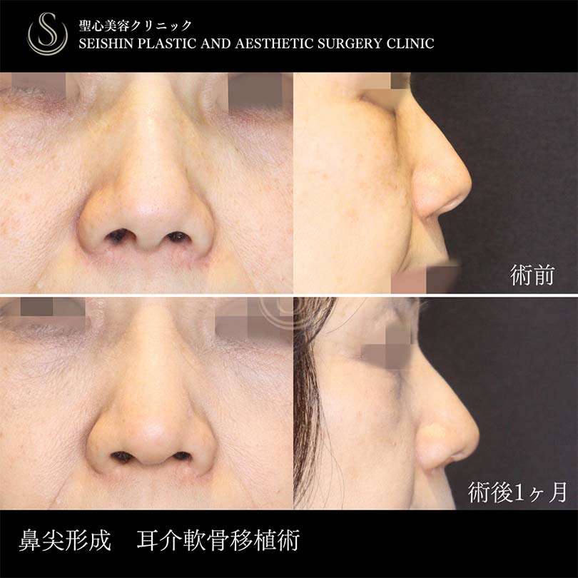 【50代女性・鼻柱にボリュームを出し、鼻先をスッと】鼻尖形成（耳介軟骨移植）、鼻尖縮小（術後1ヶ月） Before 
