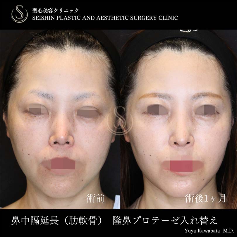 【40代女性・鼻中隔延長でツンとした鼻先に】鼻中隔延長術、鼻尖形成（耳介軟骨移植）、プロテーゼによる隆鼻術（術後1ヶ月） After 