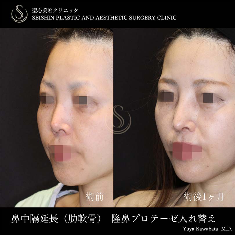 【40代女性・鼻中隔延長でツンとした鼻先に】鼻中隔延長術、鼻尖形成（耳介軟骨移植）、プロテーゼによる隆鼻術（術後1ヶ月） After 