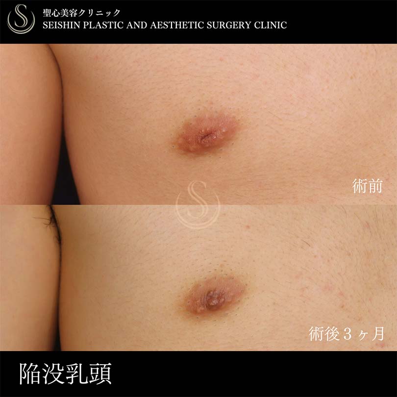 【20代男性・陥没乳頭の修正】陥没乳頭（陥没乳首）（術後3ヶ月） Before 