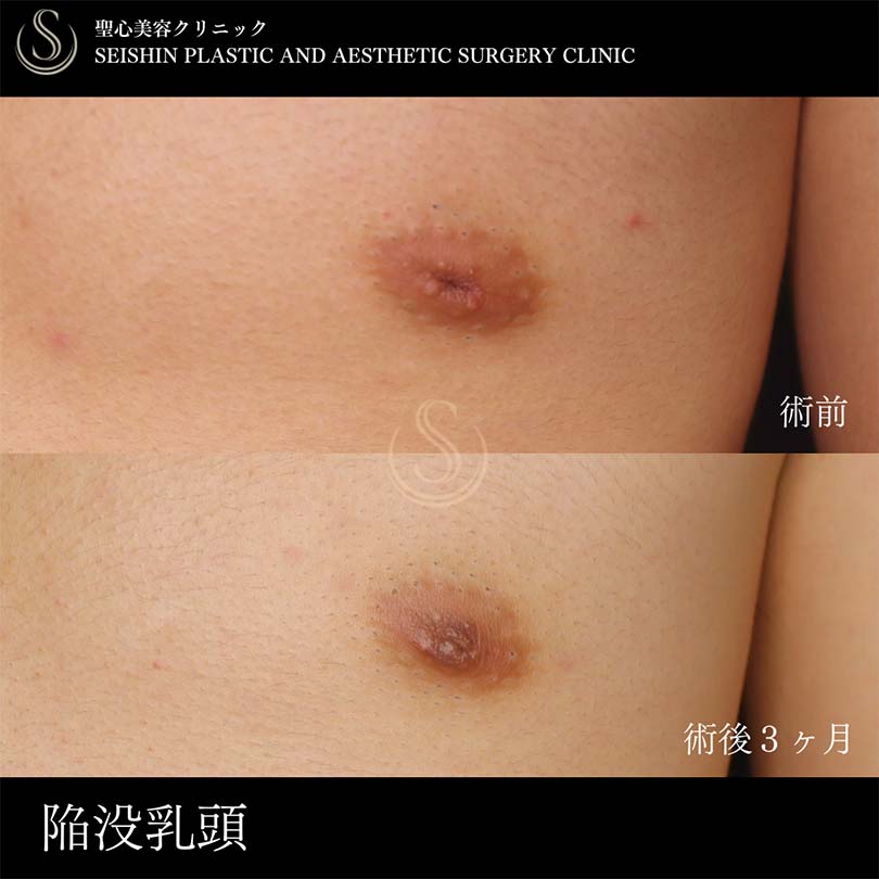 【20代男性・陥没乳頭の修正】陥没乳頭（陥没乳首）（術後3ヶ月） After 