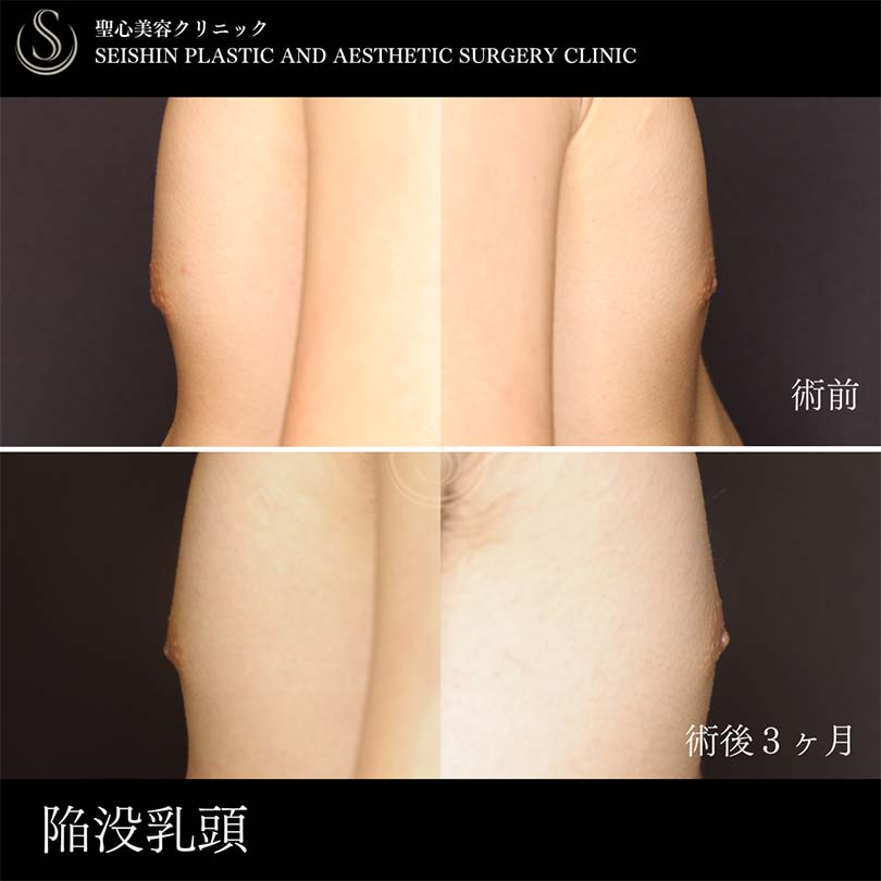 【20代男性・陥没乳頭の修正】陥没乳頭（陥没乳首）（術後3ヶ月） After 